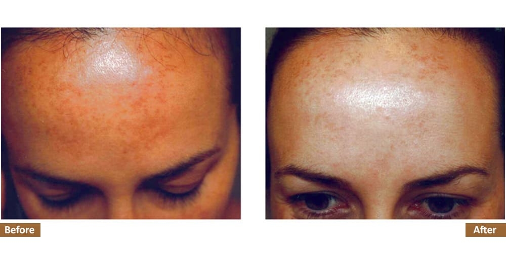 Hyperpigmentation & Melasma Before & Treatment Image