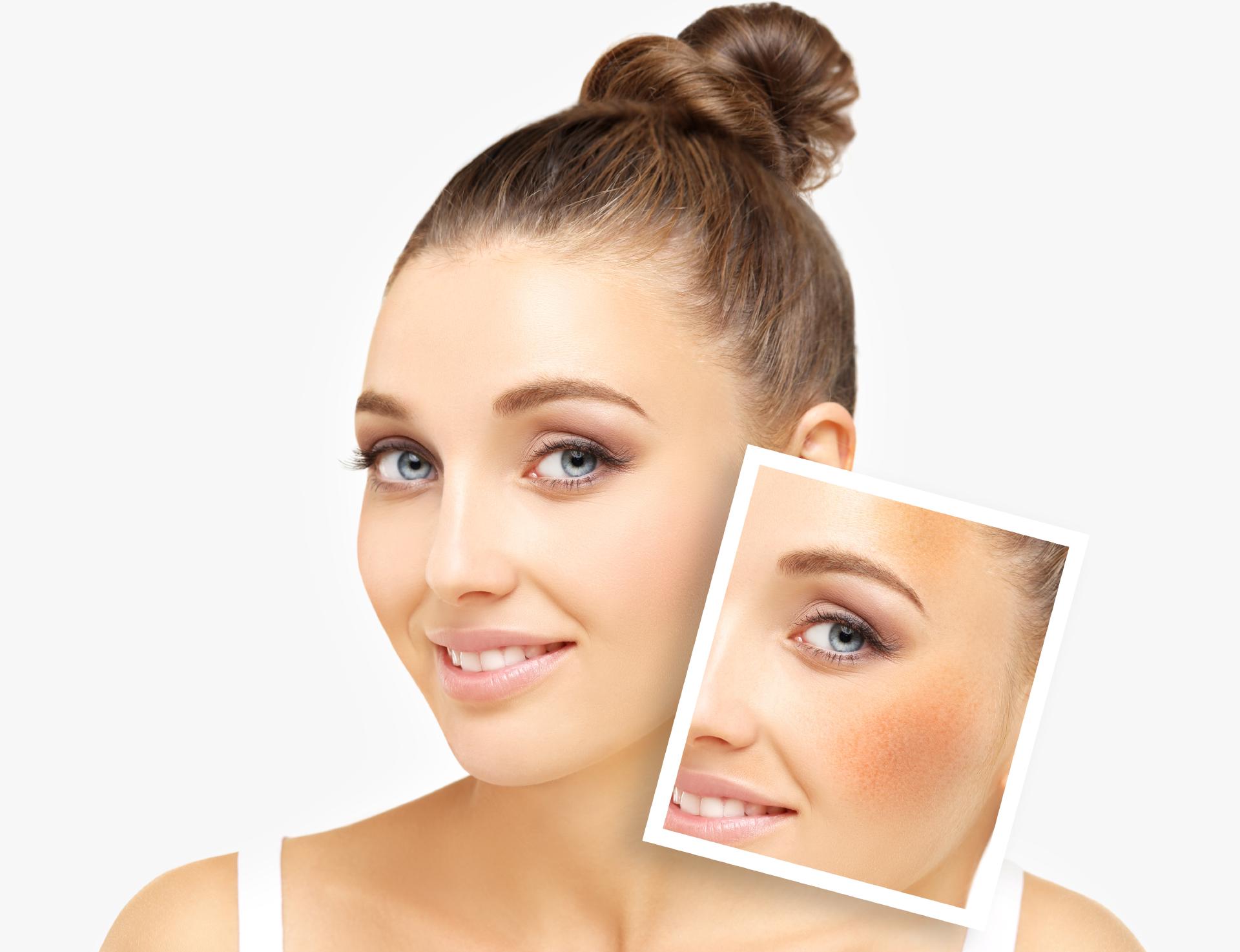 Chemical Skin Peels