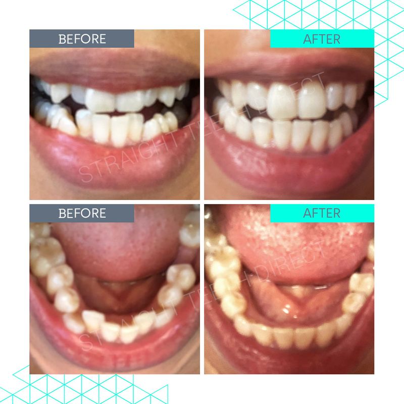straight-teeth-direct-pricing-aligner-cost-made-simple