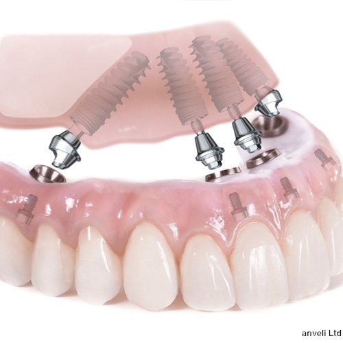 Définition d'une prothèse fixe sur implants dentaires