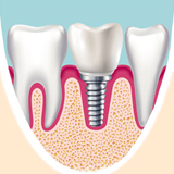 Surgery - traditional dental implants