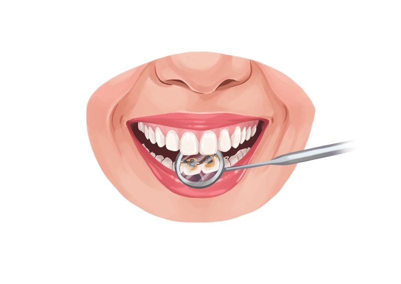 Lingual braces