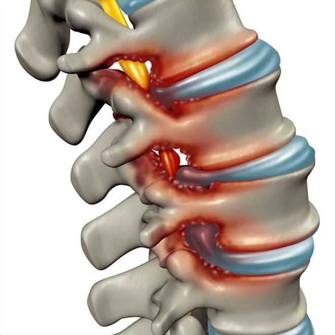 spinal stenosis 1