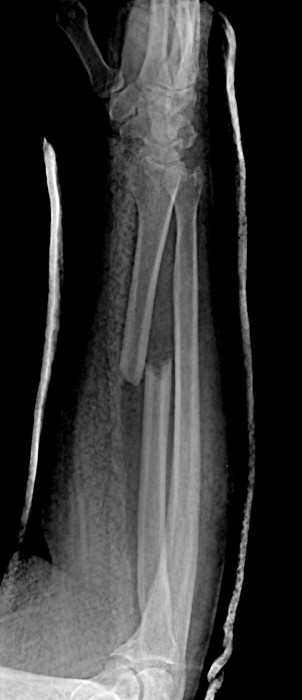 Radial_Shaft_Pre_rs1.jpg