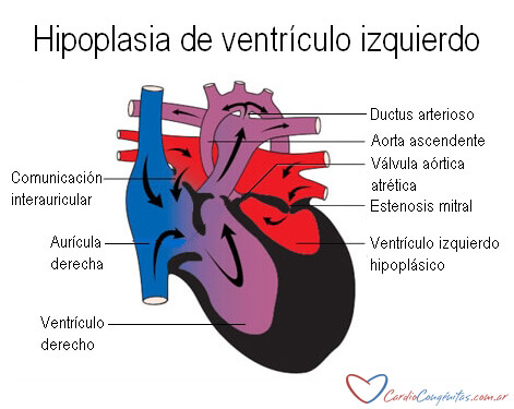 Anatomia-HLHS