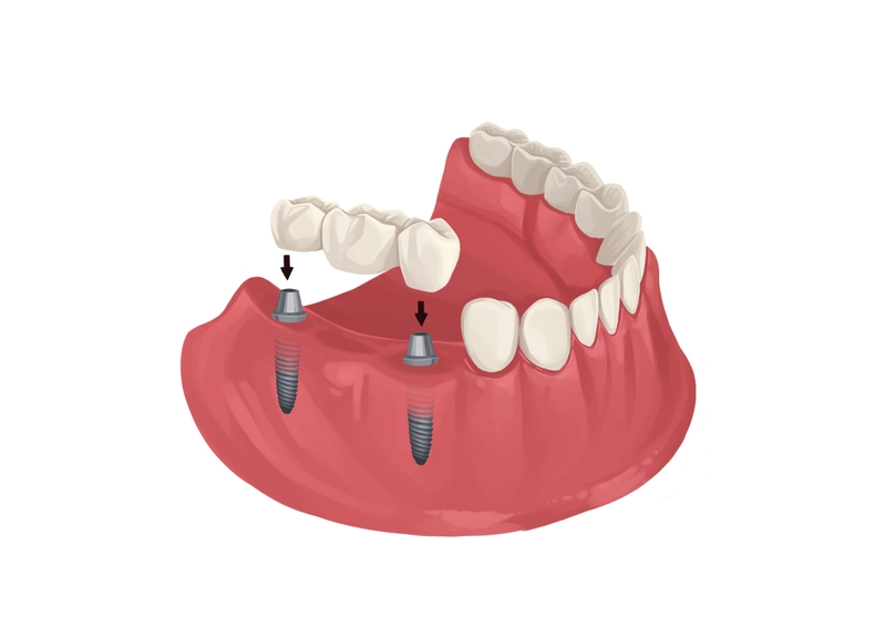 Implant bridge back teeth lower arch