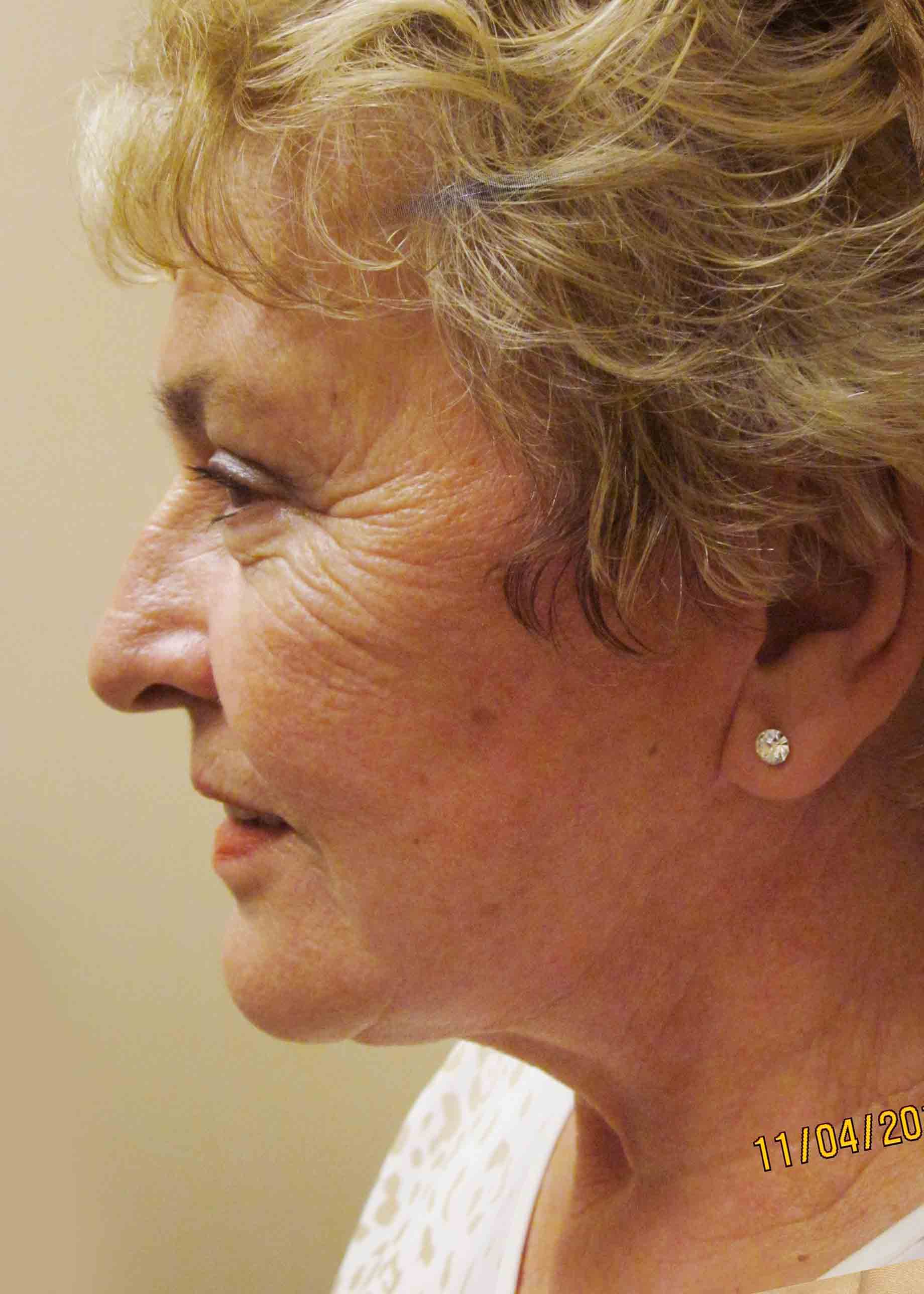 12730-4-post-frontal-facelift.JPG