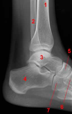 Ankle radiograph - Lateral projection.