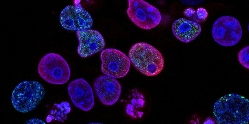 Human colorectal cancer cells stained purple, blue, and green under a microscope.