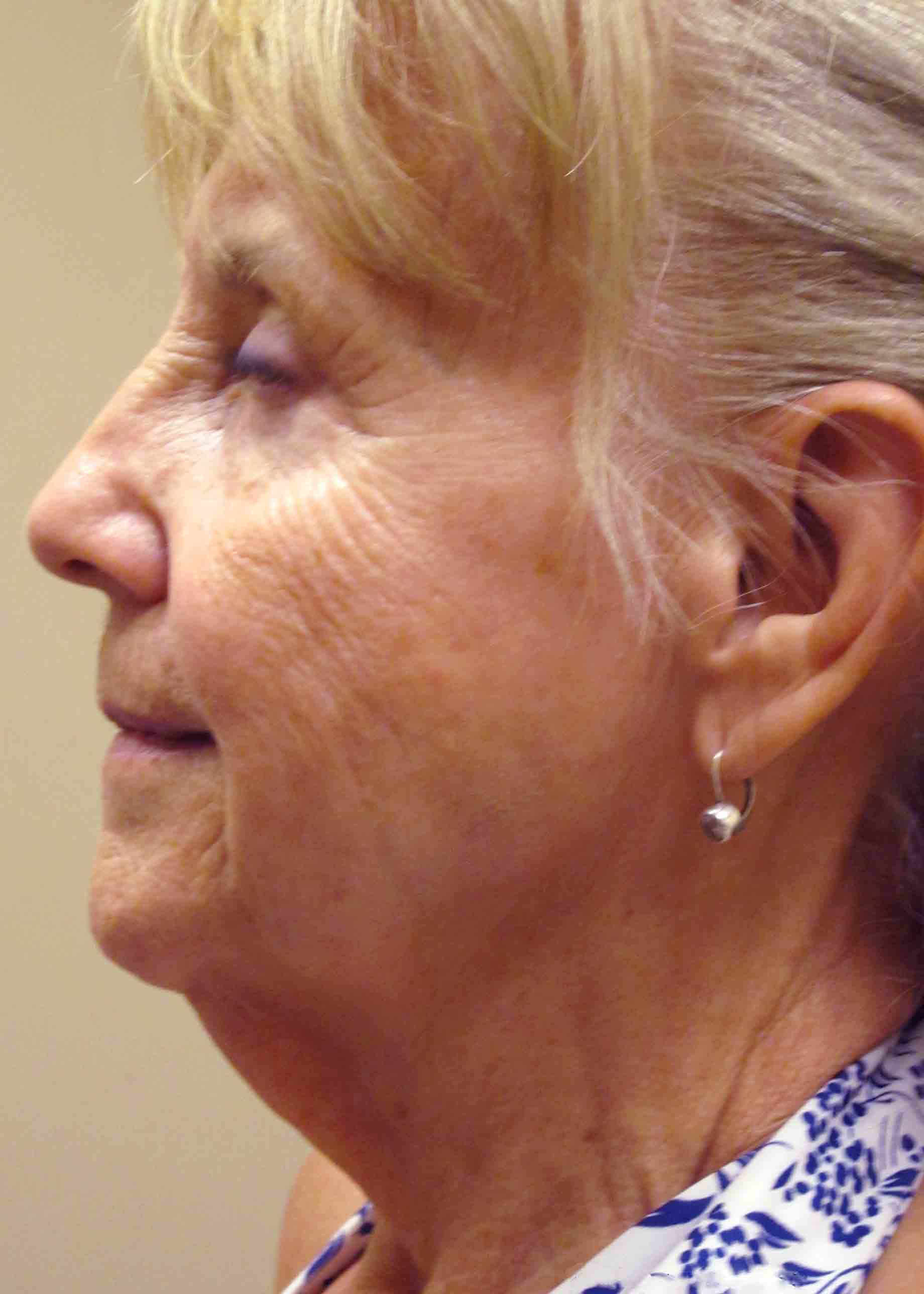 6296-3-preop-facelift-profile.jpg