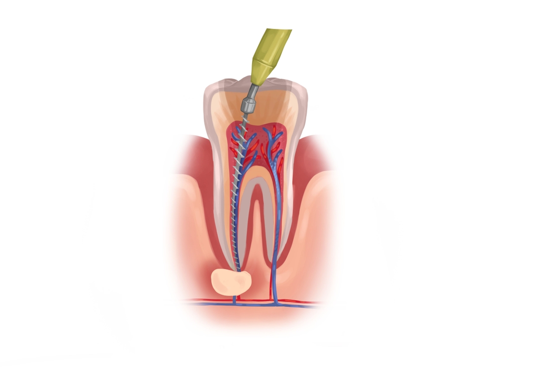 Root canal treatment costs from 700 up to 2,100