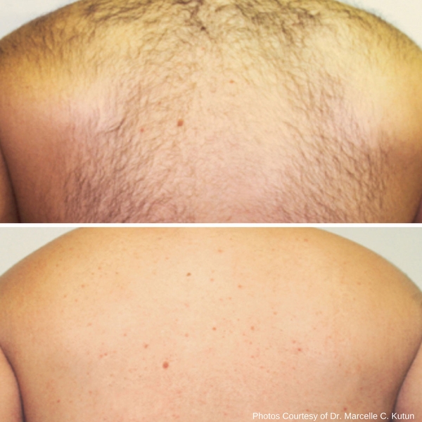 before-after-laser-hair-removal-1