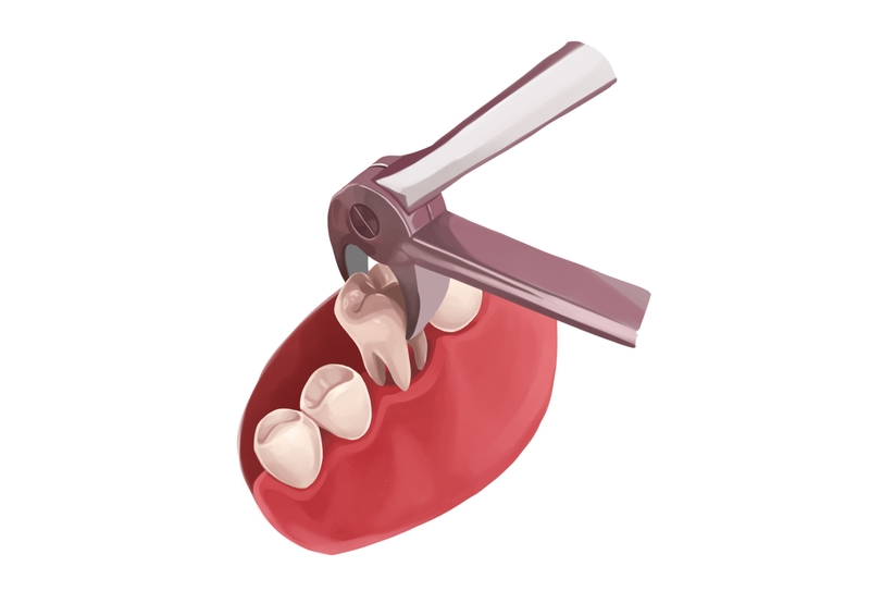 Tooth extraction procedure