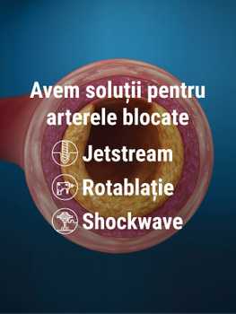 Avem soluții pentru arterele blocate – Trei metode de dezobstrucție arterială la ARES