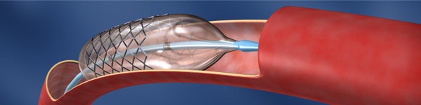 Tratament minim invaziv pentru SPP | Centrele Ares | Angiologie Pediatrica