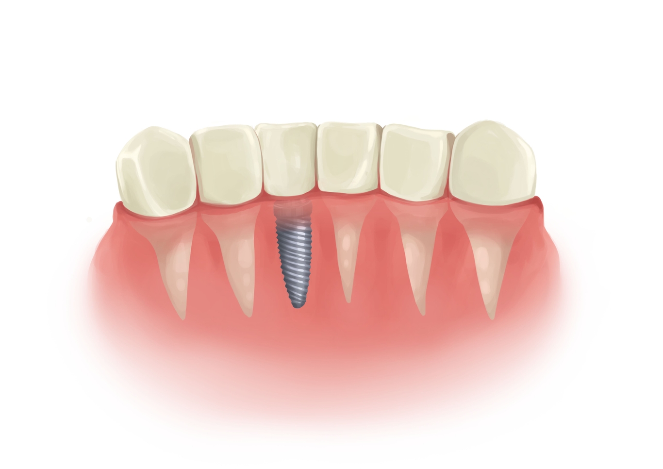 Dental implants cost from $3,500 up to $28,000