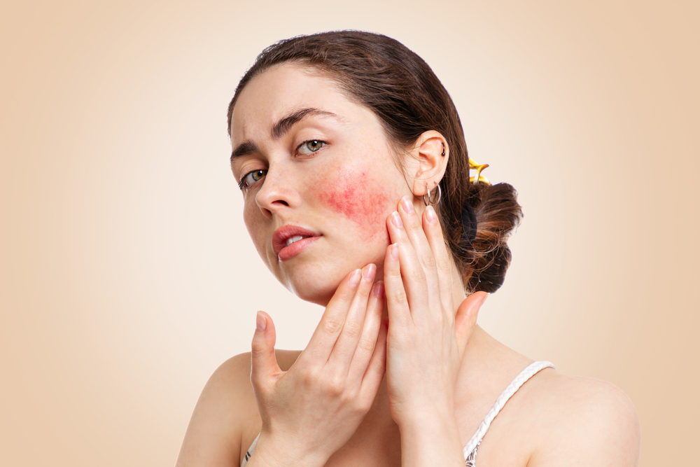 Rosacea: Overview, Symptoms and Treatment
