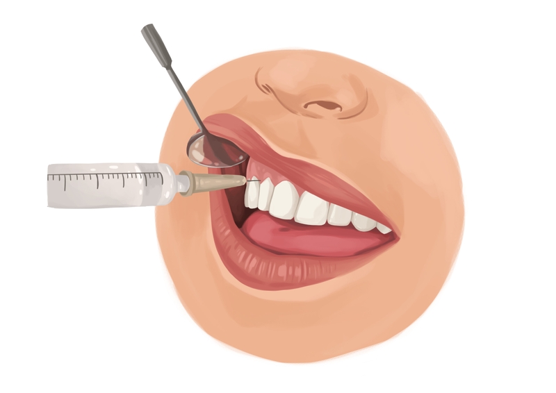 Local dental anesthesia by injection