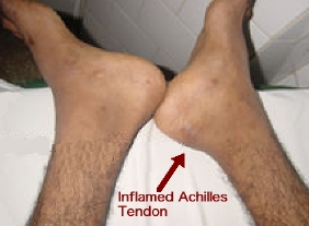 "Plantar