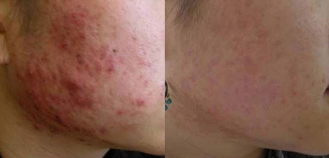 Acne Scar Treatment and Scars Removal