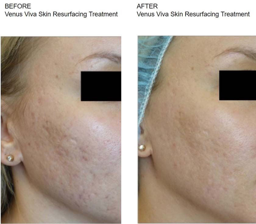 before & after - Skin Resurfacing Laser Treatments