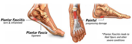 "Plantar