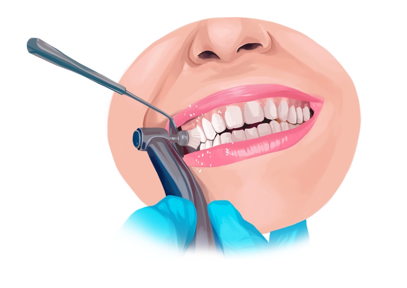 Teeth cleaning procedure