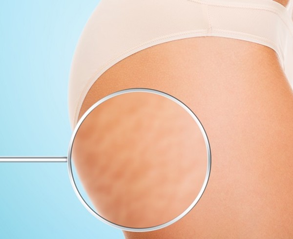 Best Treatments for Removing Cellulite