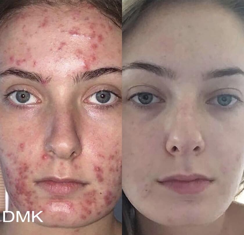 DMK Enzyme Therapy Before & After