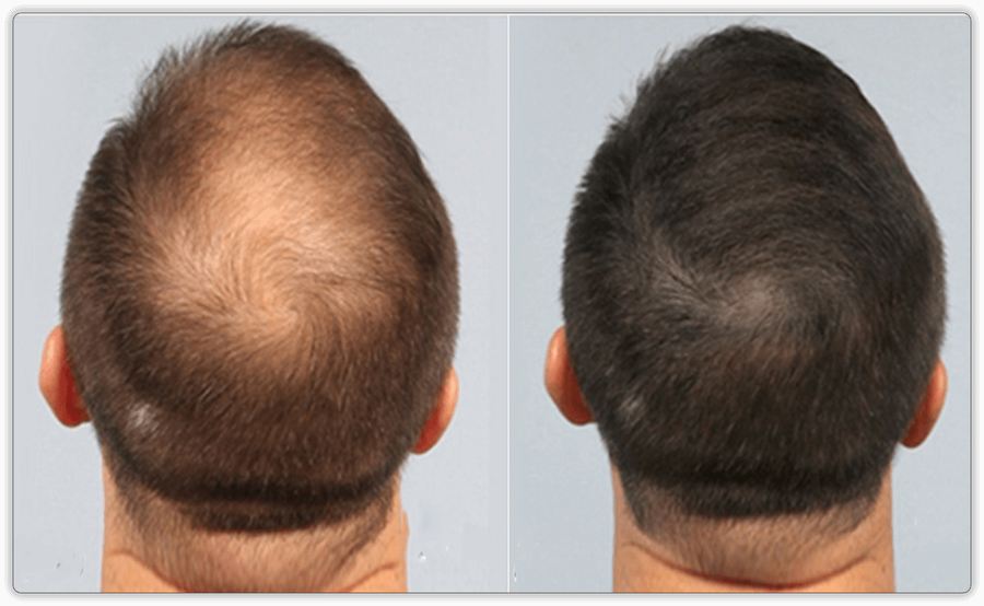 Traction Alopecia in African American BaumanPRP · Bauman Medical