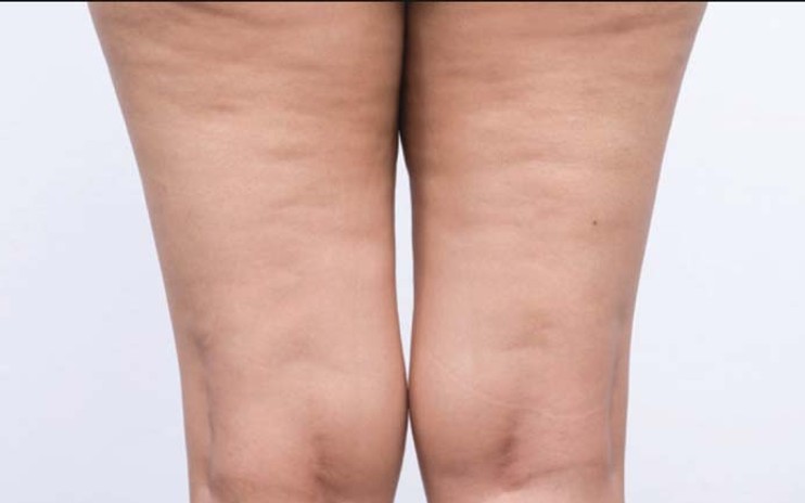 There are many reasons why women can get cellulite.