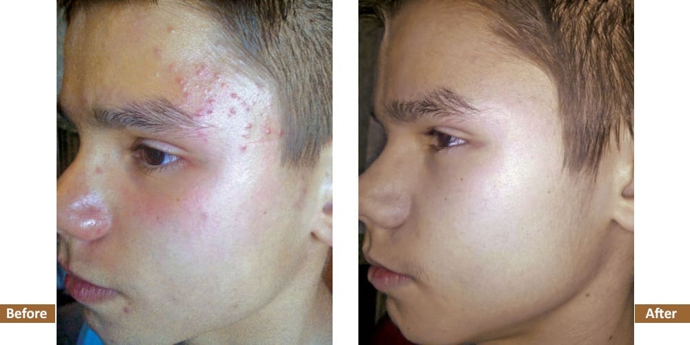 Virtual Acne Program Before & After Treatment Image