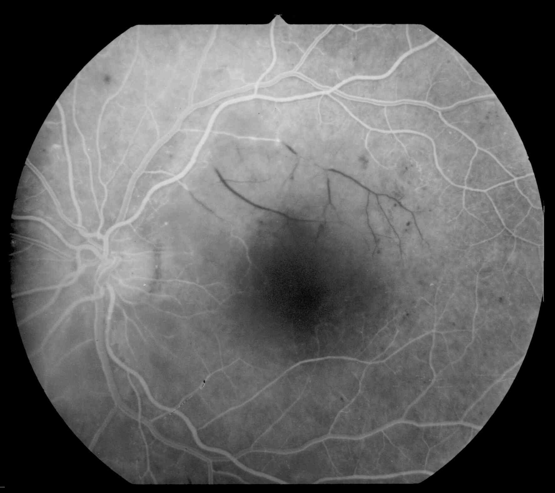 Emptied retinal venules due to arterial branch occlusion in diabetic retinopathy (fluorescein angiography). 10 June 1998. In Wikipedia. Retrieved from https://en.wikipedia.org/wiki/Diabetic_retinopathy#/media/File:Retinal_branch_occlusion_ratkaj.jpg under CC BY-SA 4.0 license.