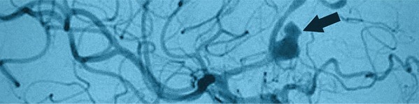 Interventie pentru anevrism cerebral | Centrele Ares | Neuroradiologie Interventionala
