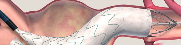 Anervrismul de aorta | Tratament minim invaziv | Centrele Ares