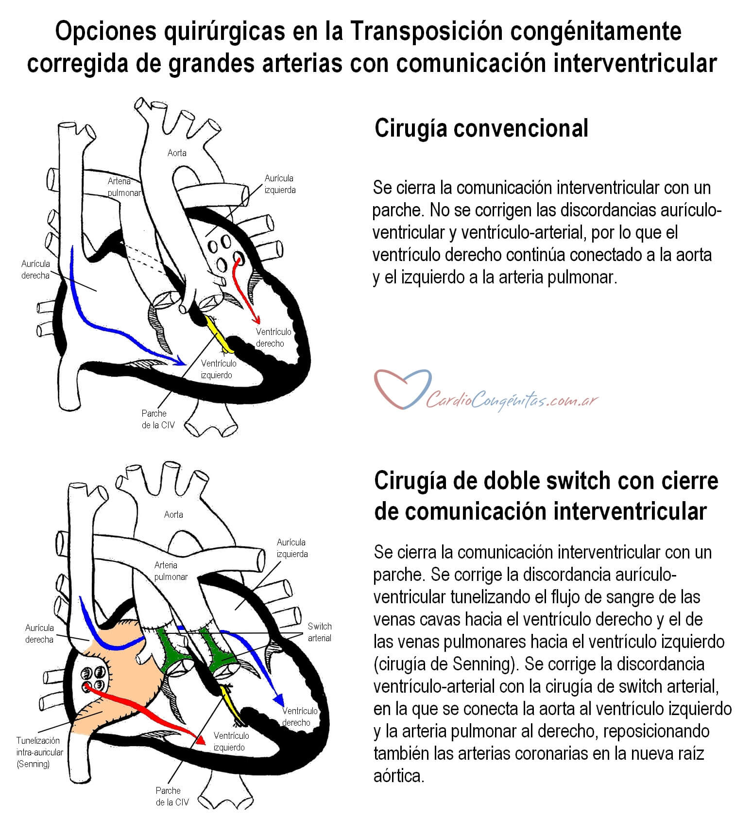 LTGA-cirugias