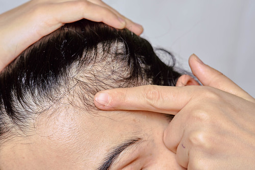 Koher Medical: Surgical vs Non surgical hair restoration
