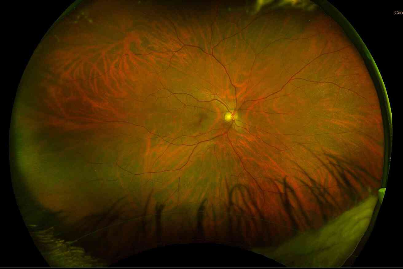 Normal retina of 50 y.o male captured using ultra-wide angle retinal camera (Optos model P200dTx)