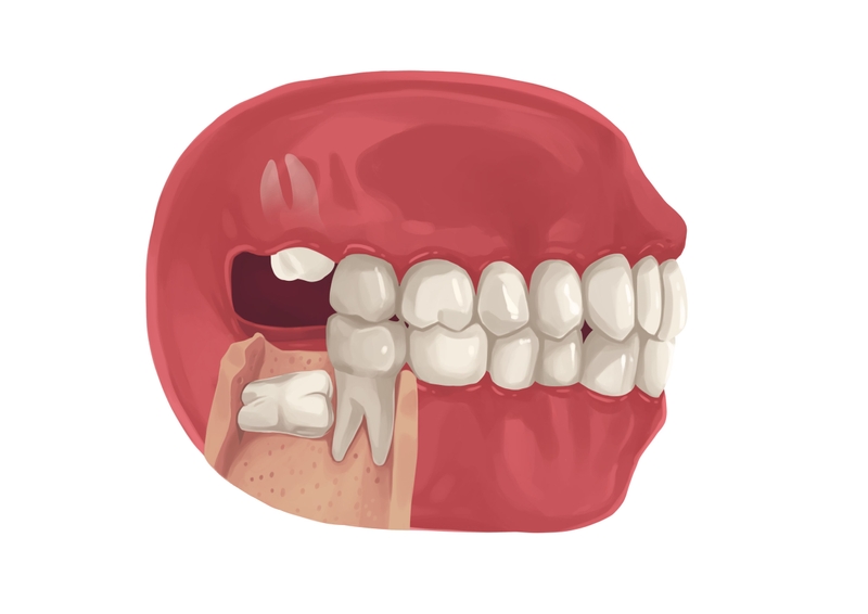 Fully bony wisdomm tooth