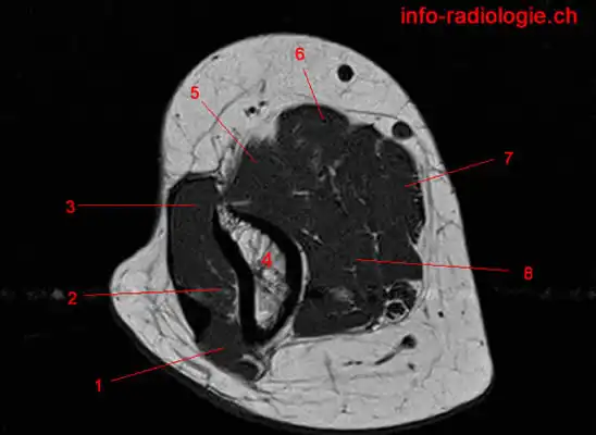 Mri Of The Elbow: Detailed Anatomy - W-radiology