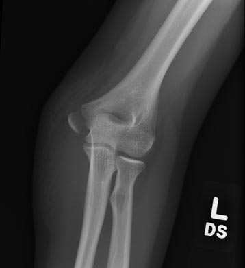 Pre-Condyle.jpg