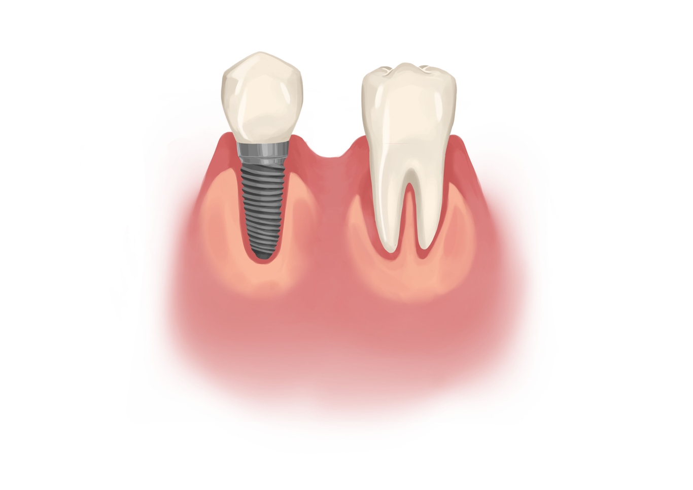 Dental implant failure rate, symptoms, and causes Authority Dental