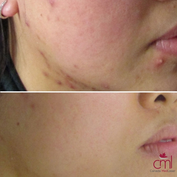 before-after-acne-2