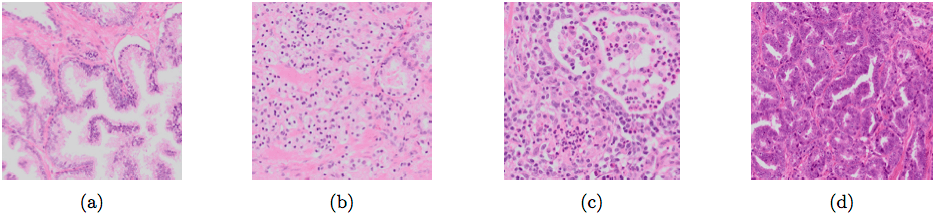 Different types of glands: normal glandular structure (a); poorly differentiated, high-grade Gleason 5 PCa (b); non-tumor epithelium surrounded by inflammation (c); Gleason 3 PCa showing color variation between slides (d).