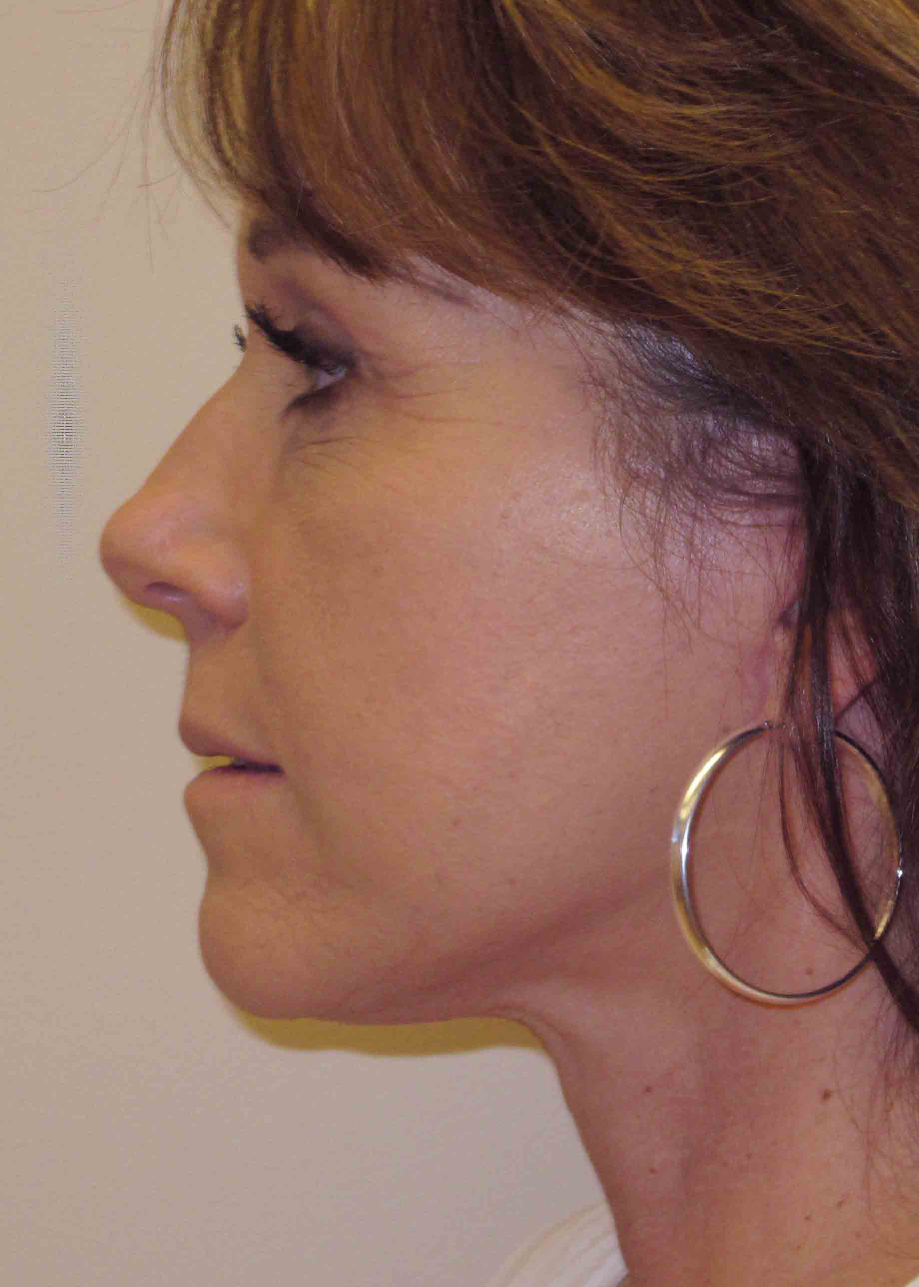 14172 4 post profile facelift.JPG