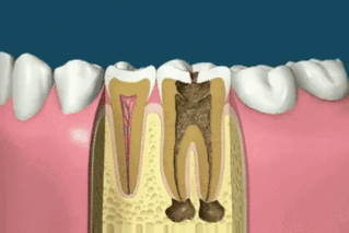 How Root Canal Treatment Can Save a Tooth - Marion Family Dental
