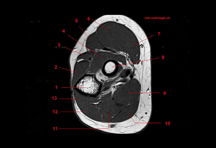 MRI of the Elbow: Detailed Anatomy