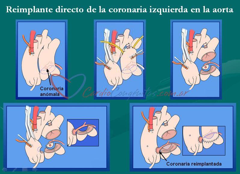 Coronaria-reimplantada
