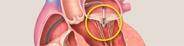 Mitraclip | Centrele Ares | Inovatie in Cardiologie