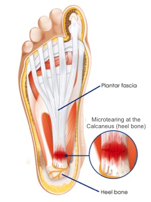 "Plantar